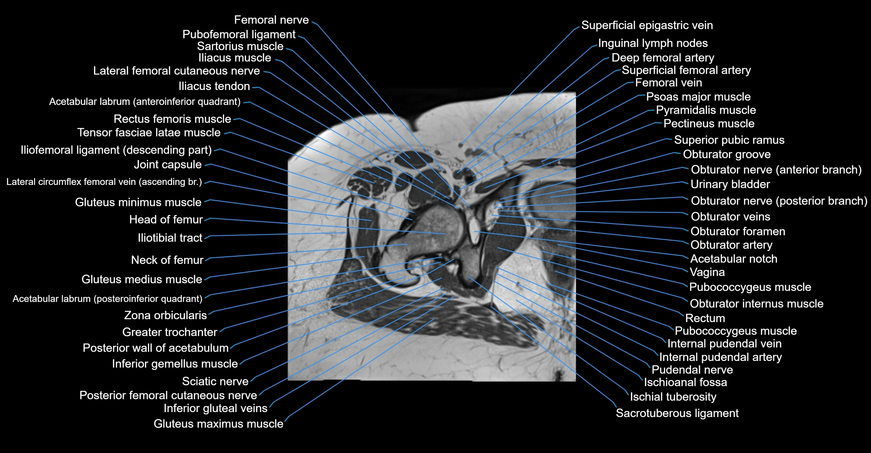 MRI hip axial cross sectional anatomy 3T 3D  radiology  anatomy image-img-00001-00045.webp